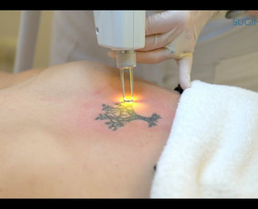 Tatuiruočių šalinimas lazeriu klinikoje SUGIHARA