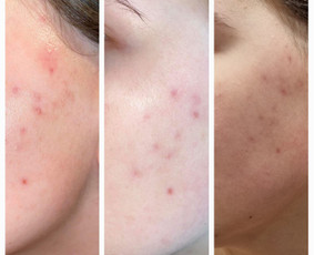 Rūgštinis veido valymas - Kosmetologė - 1