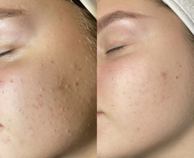 Kosmetologo paslaugos - Veido valymas - 2 Veido valymas - Kosmetologo paslaugos - 2