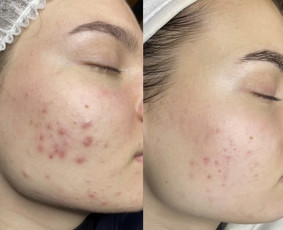 Kosmetologo paslaugos - Veido valymas - 1 Veido valymas - Kosmetologo paslaugos - 1