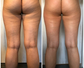 Anticeliulitinis masažas - Kosmetologo paslaugos - 4