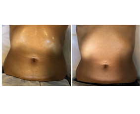 Anticeliulitinis masažas - Kosmetologo paslaugos - 3