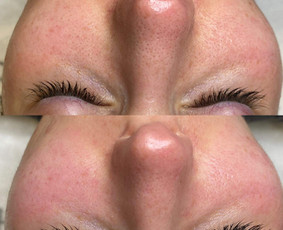 Kosmetologo paslaugos - Veido valymas - 3 Veido valymas - Kosmetologo paslaugos - 3