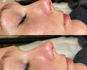 Kosmetologo paslaugos - Veido valymas - 4 Veido valymas - Kosmetologo paslaugos - 4