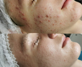 Rūgštinis veido valymas - Kosmetologė Klaipėdoje - 2