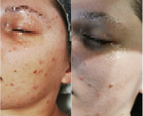 Rūgštinis veido valymas - Kosmetologė Klaipėdoje - 1