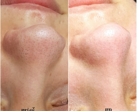 Kosmetologė Klaipėdoje - Veido valymas - 1 Veido valymas - Kosmetologė Klaipėdoje - 1