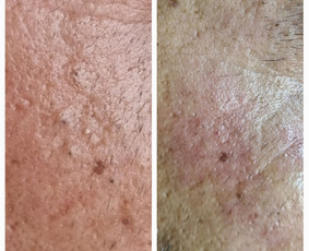 Kosmetologė - Veido valymas - 2 Veido valymas - Kosmetologė - 2