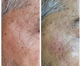 Kosmetologė - Veido valymas - 1 Veido valymas - Kosmetologė - 1