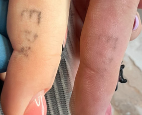 mini tatuiruotės naikinimas, efektyvus ir saugus būdas panaikinti nebepageidaujamą kūno piešinį.