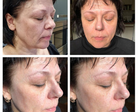 Kosmetologė - Biorevitalizacija - 1 Biorevitalizacija - Kosmetologė - 1