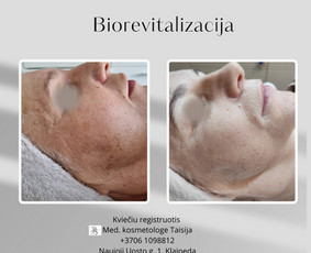 Kosmetologė - Veido procedūros - 2 Veido procedūros - Kosmetologė - 2