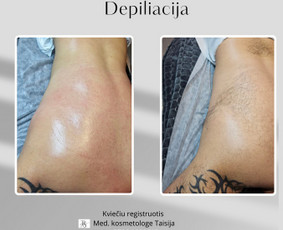 Depiliacija vašku - Kosmetologė - 2