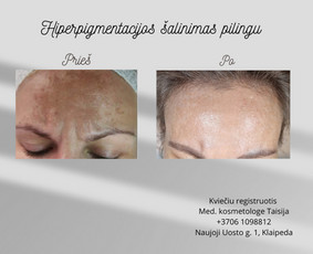 Kosmetologė - Veido procedūros - 1 Veido procedūros - Kosmetologė - 1