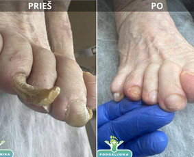 Privačios klinikos - Problematiškų nagų, pėdų pedikiūras į namus. - 1