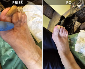 Probleminių nagų, padų, nuospaudų,varkymas jūsų namuose / Aida / Darbų pavyzdys ID 3617997