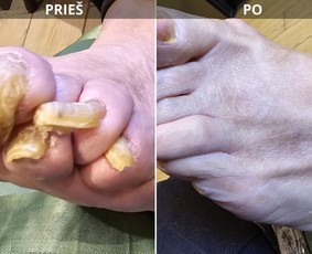 Probleminių nagų, padų, nuospaudų,varkymas jūsų namuose / Aida / Darbų pavyzdys ID 3618003