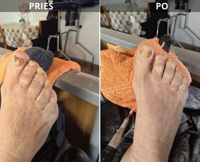 Probleminių nagų, padų, nuospaudų,varkymas jūsų namuose / Aida / Darbų pavyzdys ID 3618007