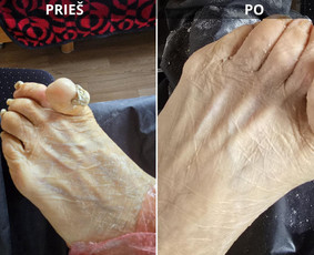 Probleminių nagų, padų, nuospaudų,varkymas jūsų namuose / Aida / Darbų pavyzdys ID 3618011