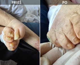 Probleminių nagų, padų, nuospaudų,varkymas jūsų namuose / Aida / Darbų pavyzdys ID 3618013