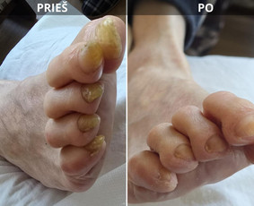 Probleminių nagų, padų, nuospaudų,varkymas jūsų namuose / Aida / Darbų pavyzdys ID 3618015