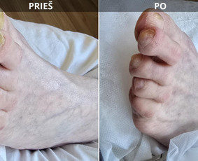 Probleminių nagų, padų, nuospaudų,varkymas jūsų namuose / Aida / Darbų pavyzdys ID 3618017