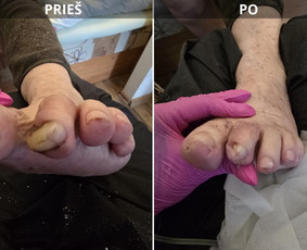 Probleminių nagų, padų, nuospaudų,varkymas jūsų namuose / Aida / Darbų pavyzdys ID 3618019