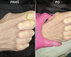 Probleminių nagų, padų, nuospaudų,varkymas jūsų namuose / Aida / Darbų pavyzdys ID 3618021