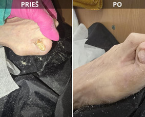 Probleminių nagų, padų, nuospaudų,varkymas jūsų namuose / Aida / Darbų pavyzdys ID 3618023