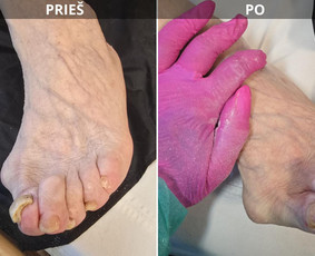 Probleminių nagų, padų, nuospaudų,varkymas jūsų namuose / Aida / Darbų pavyzdys ID 3618047
