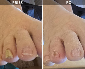 Probleminių nagų, padų, nuospaudų,varkymas jūsų namuose / Aida / Darbų pavyzdys ID 3618049