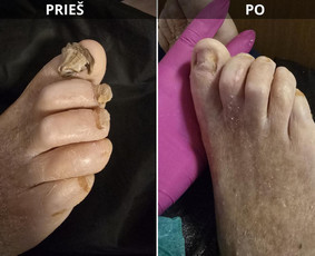 Probleminių nagų, padų, nuospaudų,varkymas jūsų namuose / Aida / Darbų pavyzdys ID 3618069