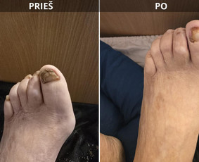 Probleminių nagų, padų, nuospaudų,varkymas jūsų namuose / Aida / Darbų pavyzdys ID 3618071