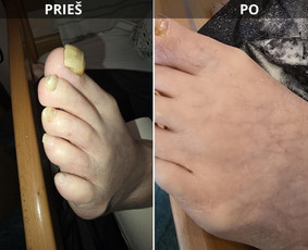 Probleminių nagų, padų, nuospaudų,varkymas jūsų namuose / Aida / Darbų pavyzdys ID 3618073