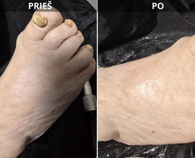 Probleminių nagų, padų, nuospaudų,varkymas jūsų namuose / Aida / Darbų pavyzdys ID 3618077