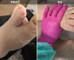 Probleminių nagų, padų, nuospaudų,varkymas jūsų namuose / Aida / Darbų pavyzdys ID 3618079