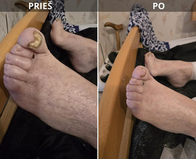 Probleminių nagų, padų, nuospaudų,varkymas jūsų namuose / Aida / Darbų pavyzdys ID 3618081
