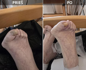 Probleminių nagų, padų, nuospaudų,varkymas jūsų namuose / Aida / Darbų pavyzdys ID 3618083