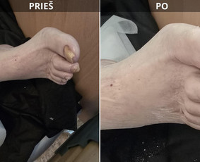 Probleminių nagų, padų, nuospaudų,varkymas jūsų namuose / Aida / Darbų pavyzdys ID 3618085