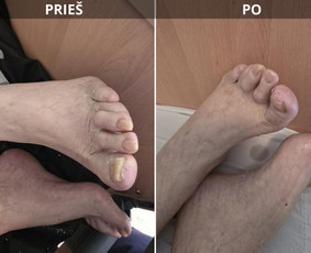 Probleminių nagų, padų, nuospaudų,varkymas jūsų namuose / Aida / Darbų pavyzdys ID 3618089