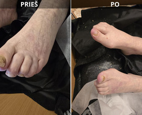 Probleminių nagų, padų, nuospaudų,varkymas jūsų namuose / Aida / Darbų pavyzdys ID 3618109