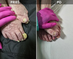Probleminių nagų, padų, nuospaudų,varkymas jūsų namuose / Aida / Darbų pavyzdys ID 3618113