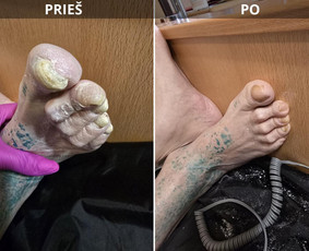 Probleminių nagų, padų, nuospaudų,varkymas jūsų namuose / Aida / Darbų pavyzdys ID 3618115