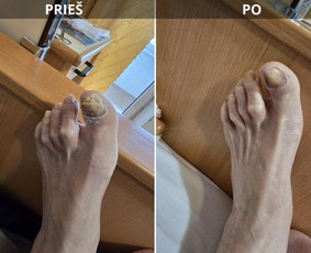 Probleminių nagų, padų, nuospaudų,varkymas jūsų namuose / Aida / Darbų pavyzdys ID 3618121