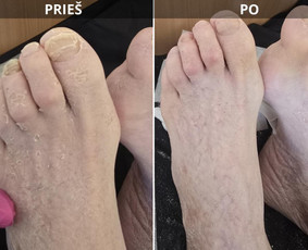 Probleminių nagų, padų, nuospaudų,varkymas jūsų namuose / Aida / Darbų pavyzdys ID 3618125