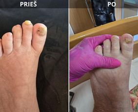 Probleminių nagų, padų, nuospaudų,varkymas jūsų namuose / Aida / Darbų pavyzdys ID 3618131