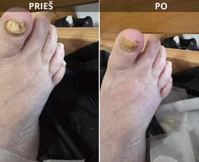Probleminių nagų, padų, nuospaudų,varkymas jūsų namuose / Aida / Darbų pavyzdys ID 3618133