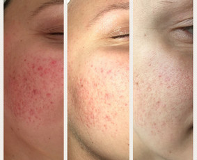 Rūgščių terapija tinka aknės bei rožinių spuogų korekcijai. Atliekama su Sesderma rūgštimis.