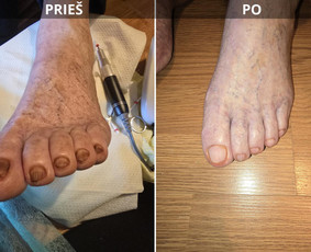 Probleminių nagų, padų, nuospaudų,varkymas jūsų namuose / Aida / Darbų pavyzdys ID 3664757