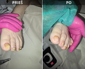 Probleminių nagų, padų, nuospaudų,varkymas jūsų namuose / Aida / Darbų pavyzdys ID 3664759
